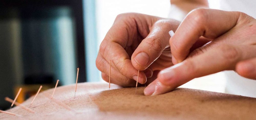 Akupunktura